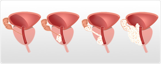 psa cancer de prostata